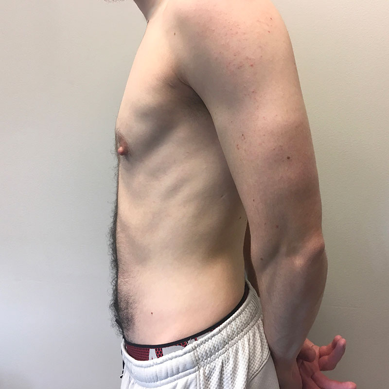 Female To Male Top Surgery 05