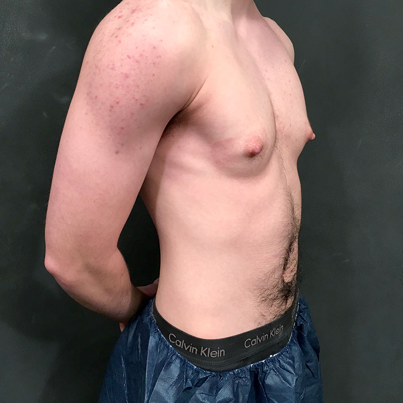 Female To Male Top Surgery 07