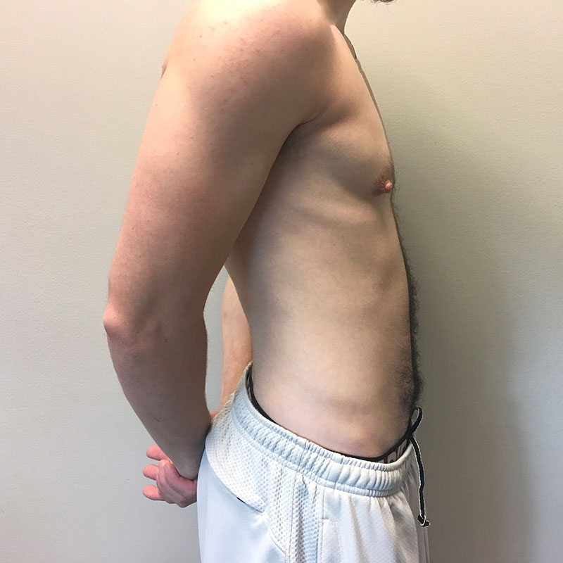 Female To Male Top Surgery 09