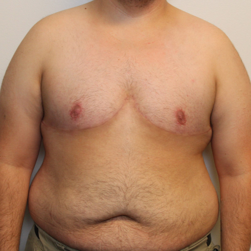 Female To Male Top Surgery 113