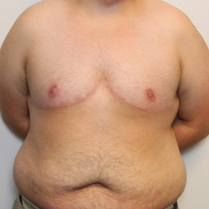 Female To Male Top Surgery 03