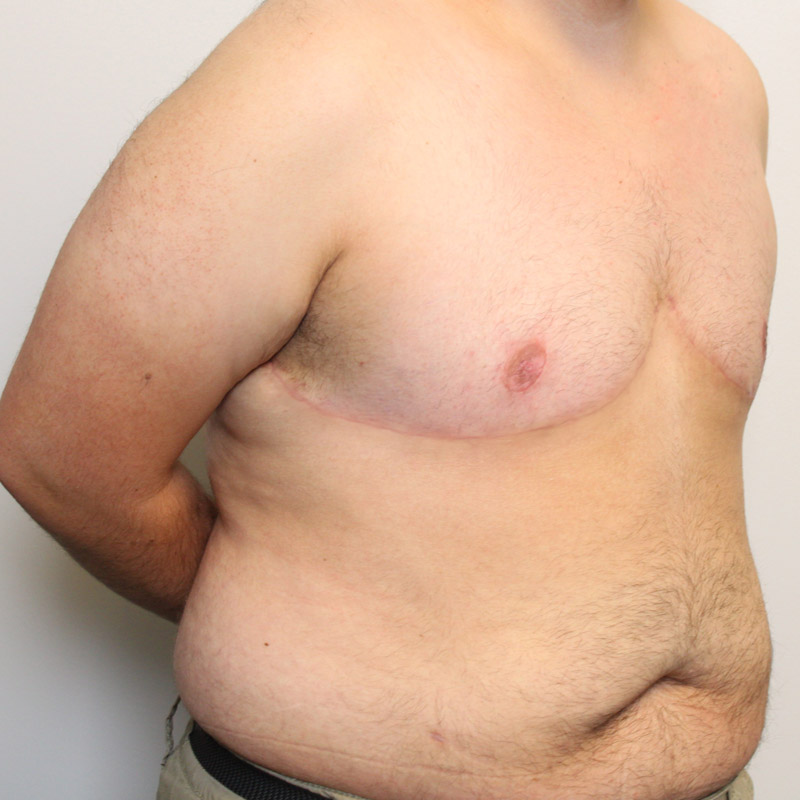 Female To Male Top Surgery 07