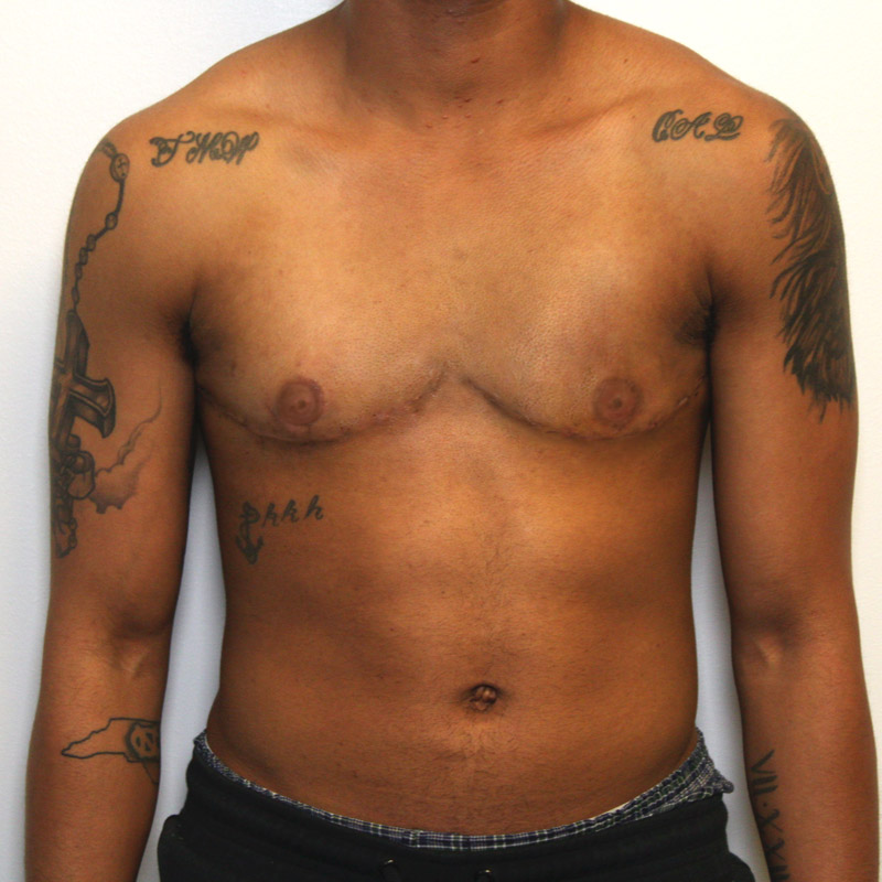 Female To Male Top Surgery 114