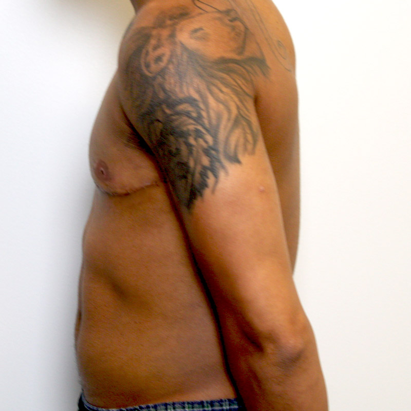 Female To Male Top Surgery 05