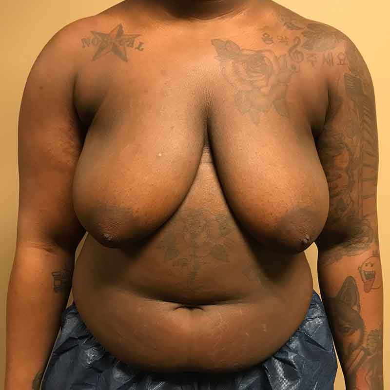 Female To Male Top Surgery 01