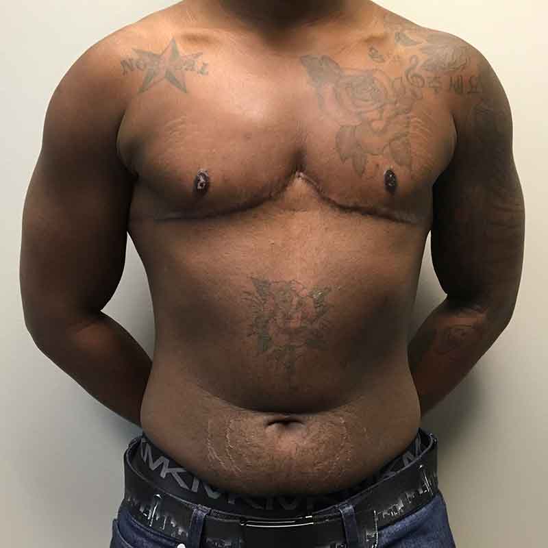 Female To Male Top Surgery 12