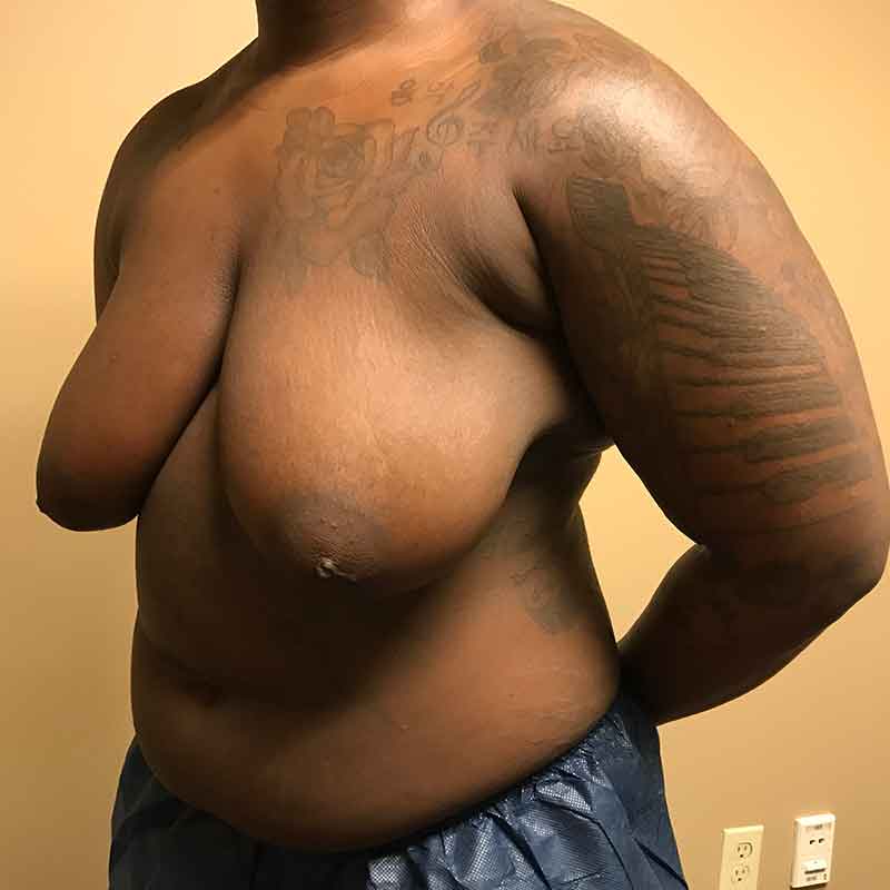 Female To Male Top Surgery 03