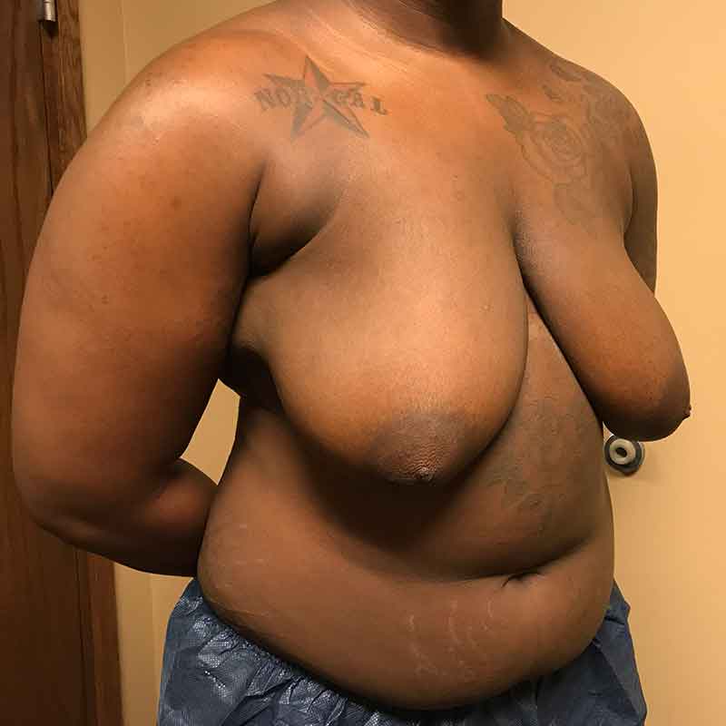 Female To Male Top Surgery 05