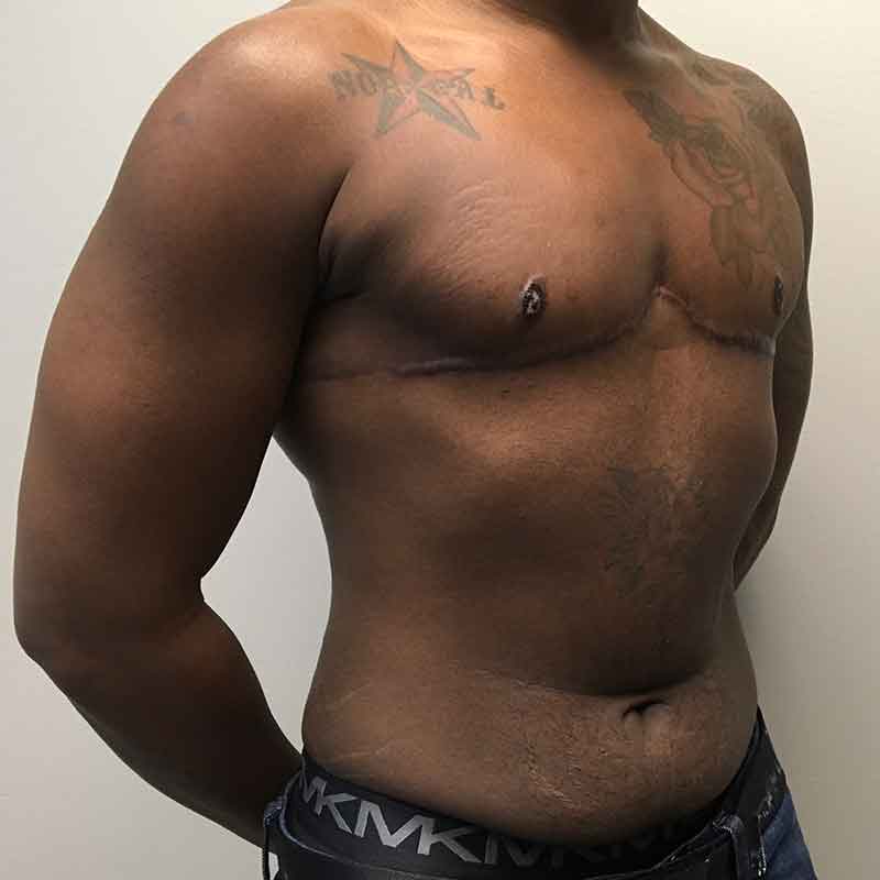 Female To Male Top Surgery 05