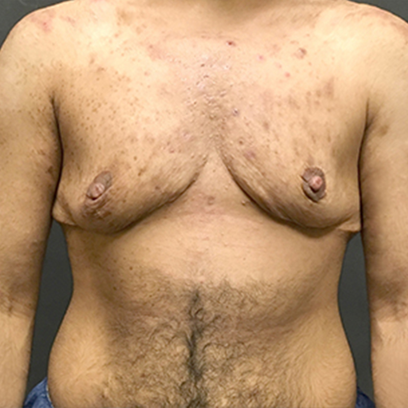 Female To Male Top Surgery 01