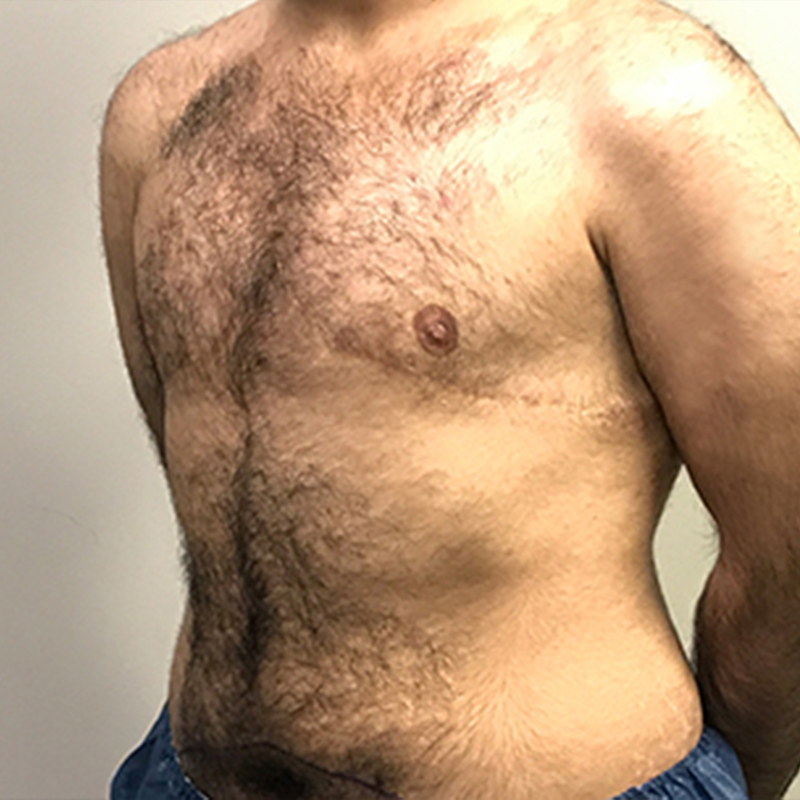 Female To Male Top Surgery 03