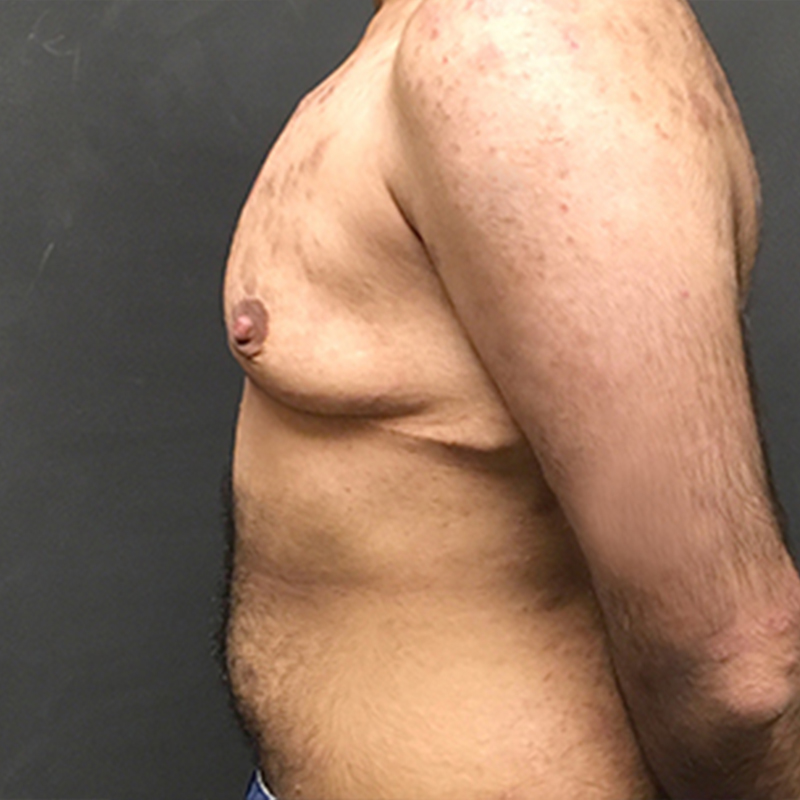 Female To Male Top Surgery 05