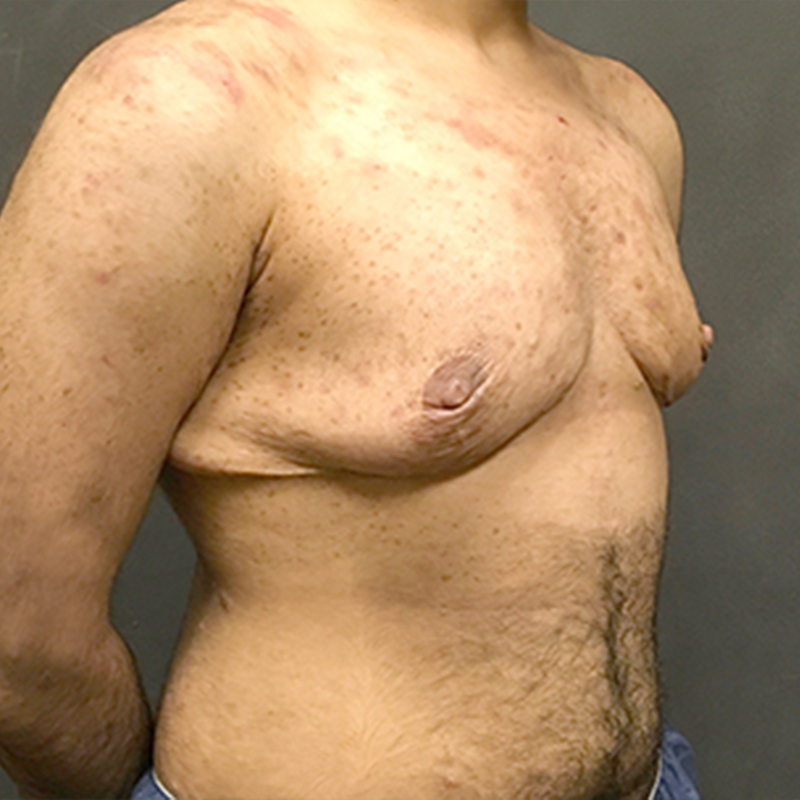 Female To Male Top Surgery 07