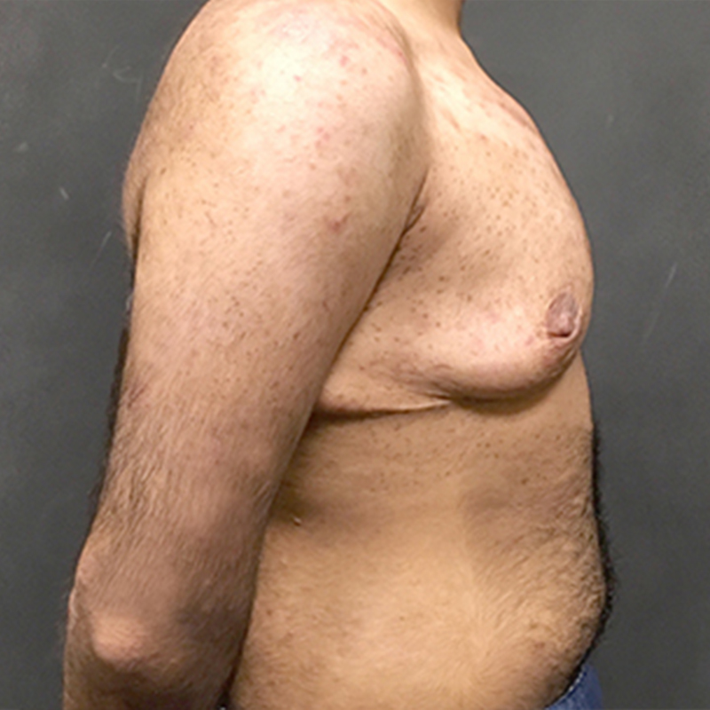 Female To Male Top Surgery 09