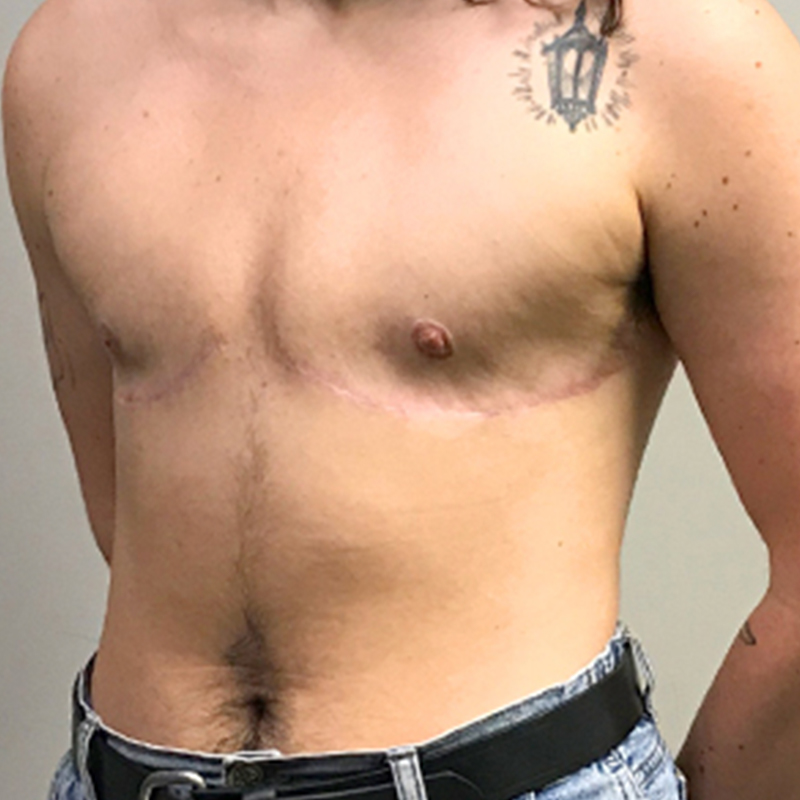 Female To Male Top Surgery 03