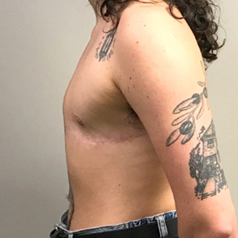 Female To Male Top Surgery 05