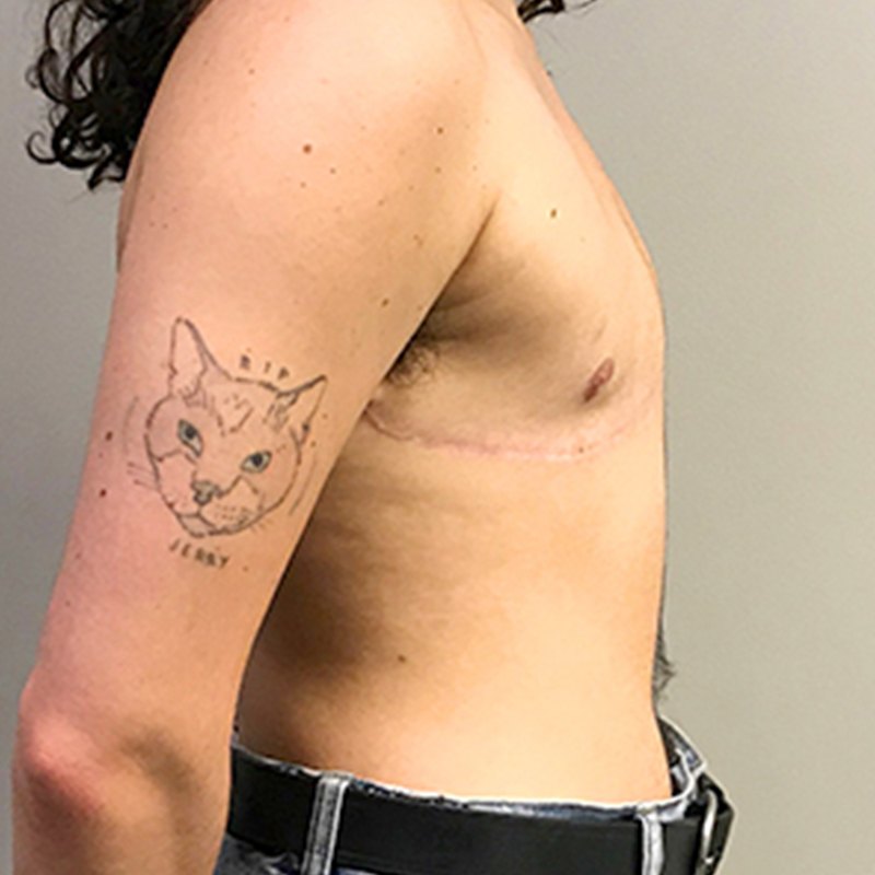 Female To Male Top Surgery 09