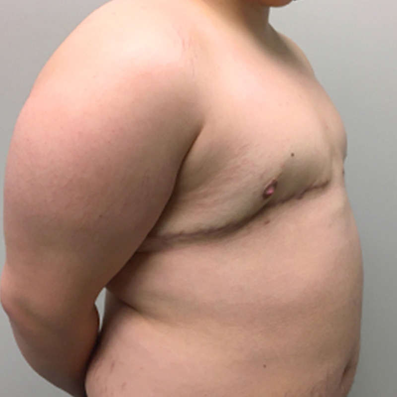 Female To Male Top Surgery 03