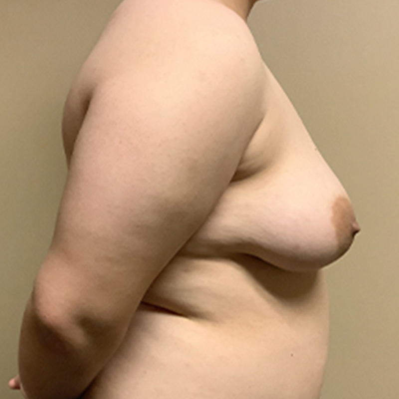 Female To Male Top Surgery 05