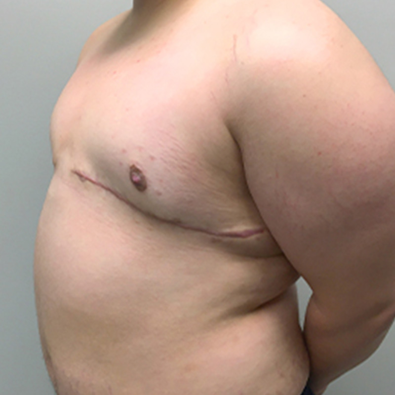 Female To Male Top Surgery 07