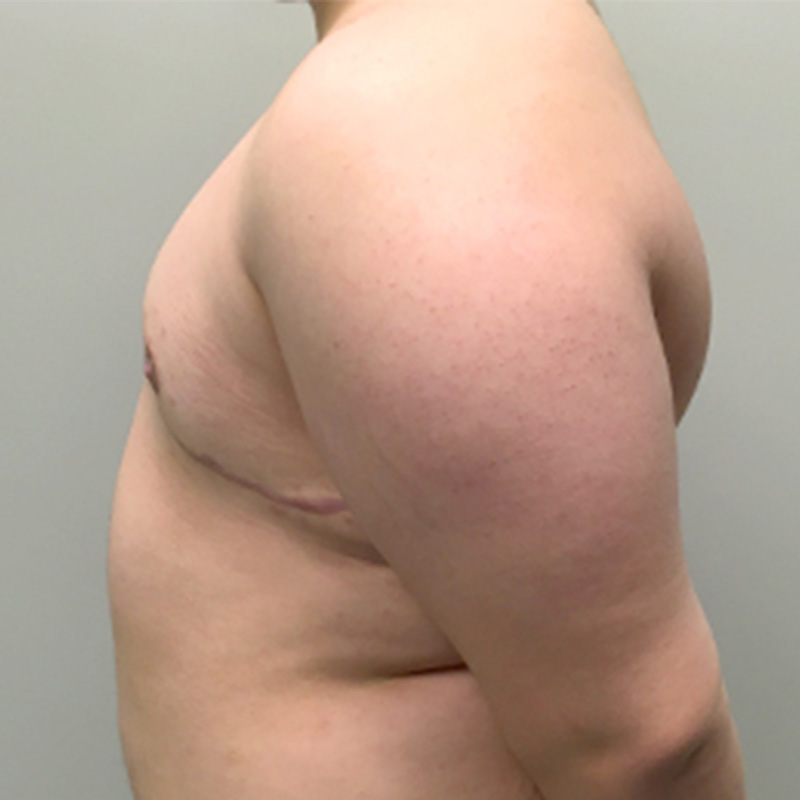 Female To Male Top Surgery 09