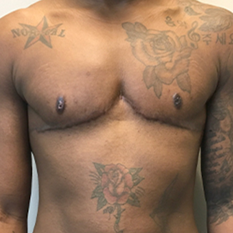 Female To Male Top Surgery 16