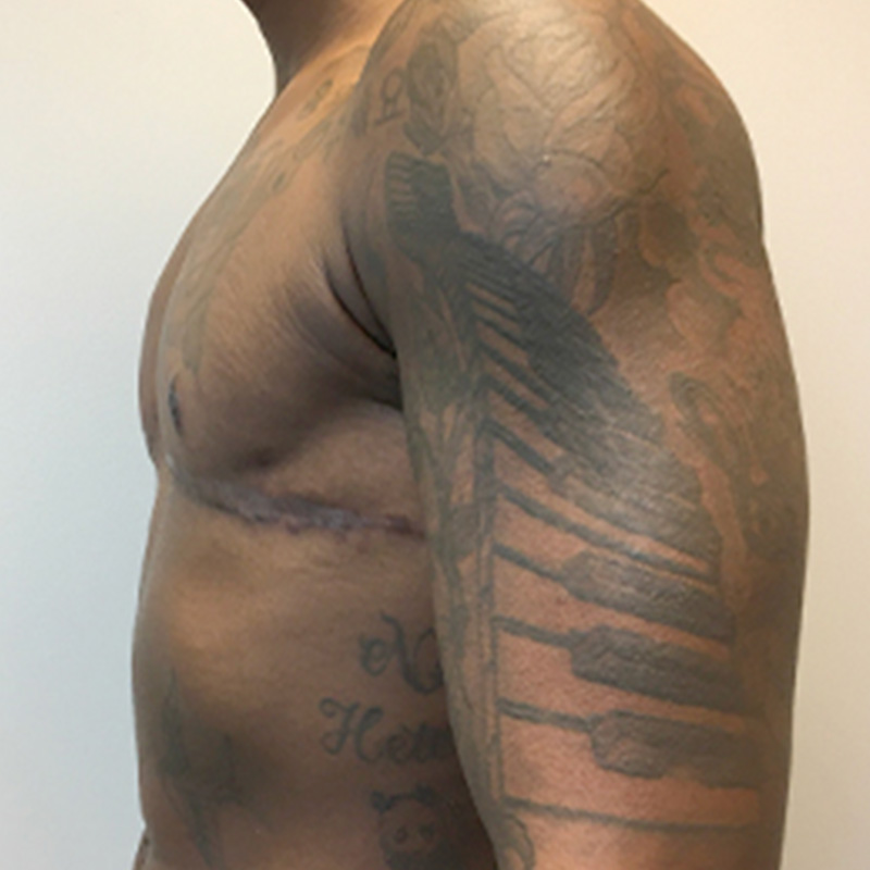 Female To Male Top Surgery 05