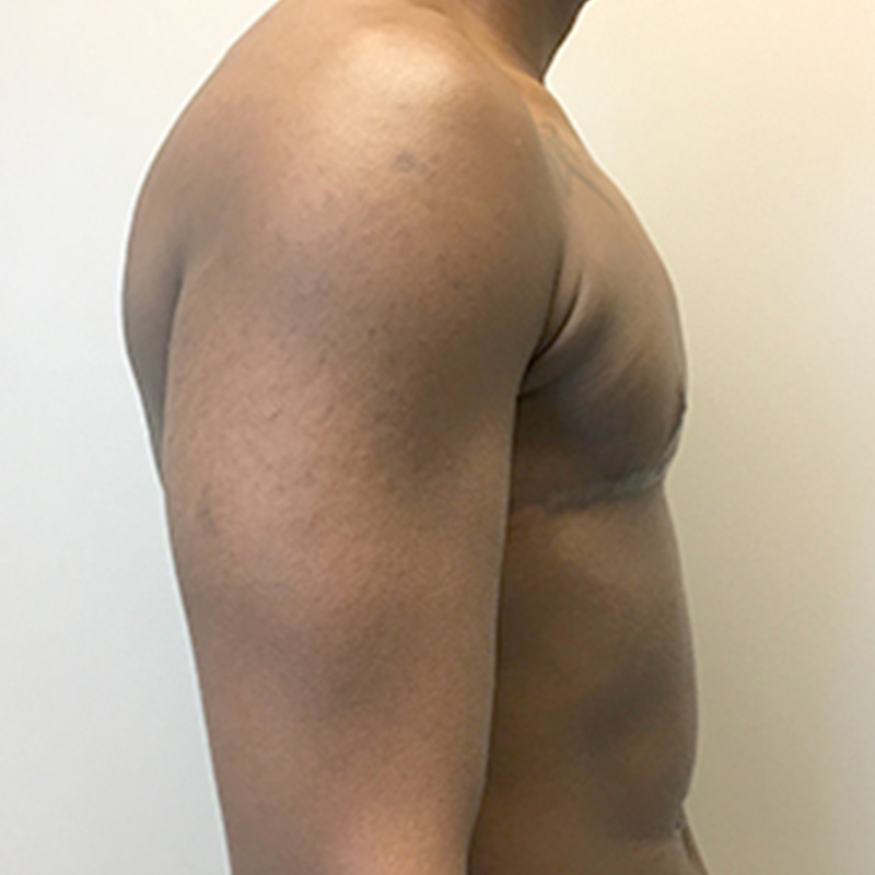 Female To Male Top Surgery 09