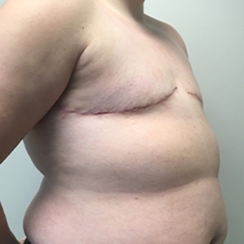 Female To Male Top Surgery 03