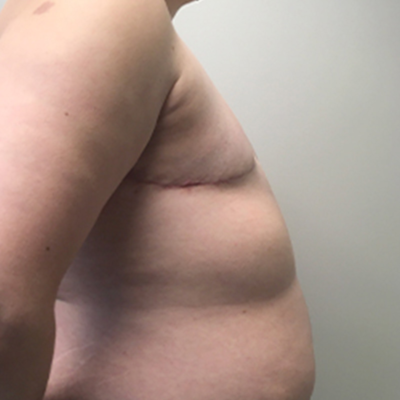 Female To Male Top Surgery 05