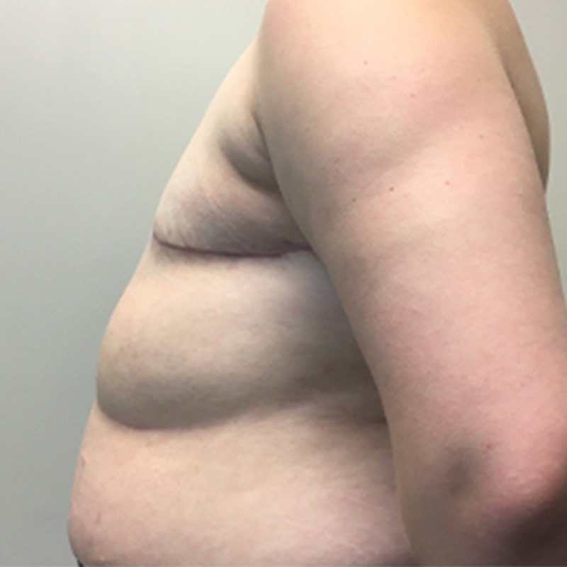 Female To Male Top Surgery 09