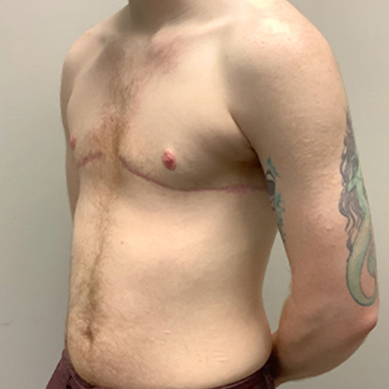 Female To Male Top Surgery 03