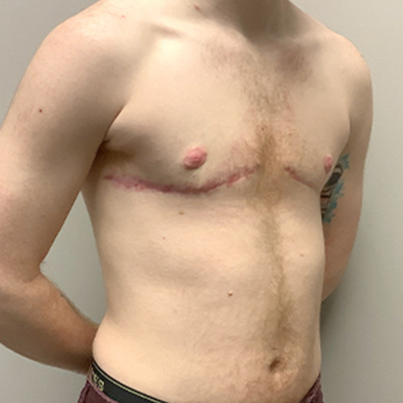 Female To Male Top Surgery 07