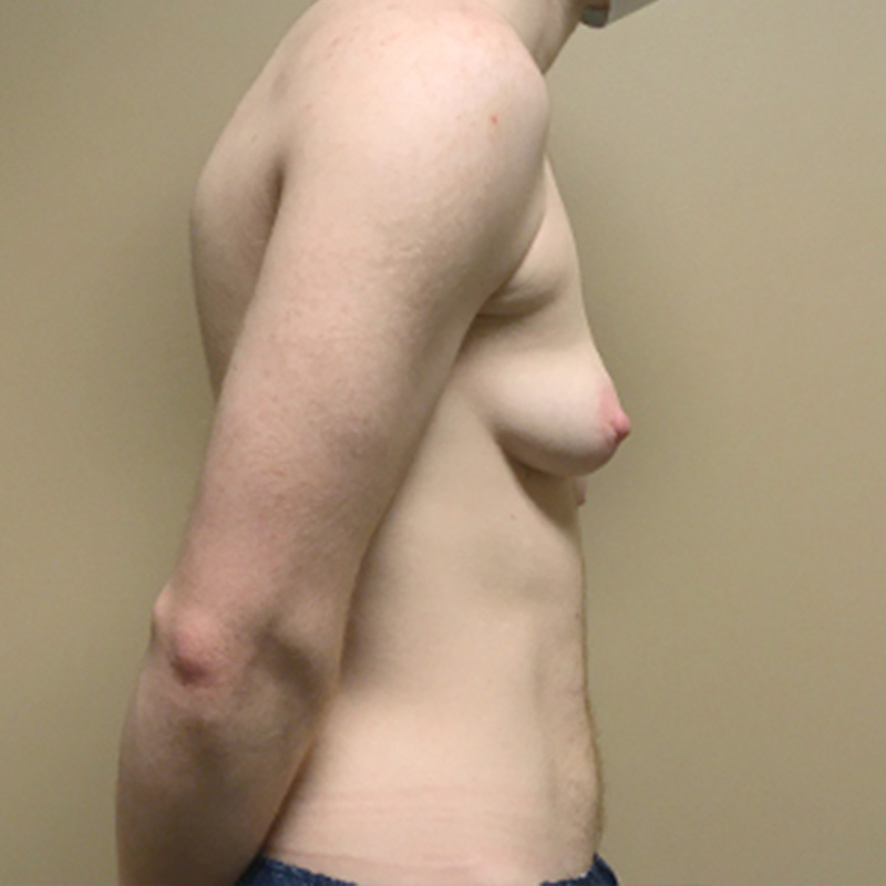 Female To Male Top Surgery 09