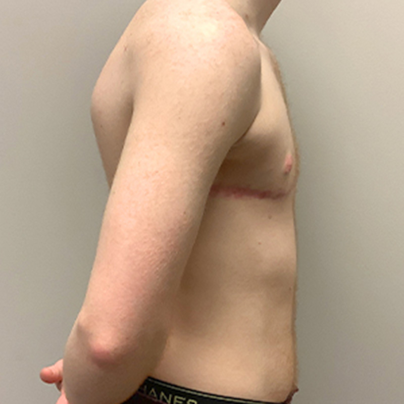 Female To Male Top Surgery 09