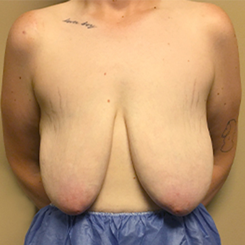 Female To Male Top Surgery 01