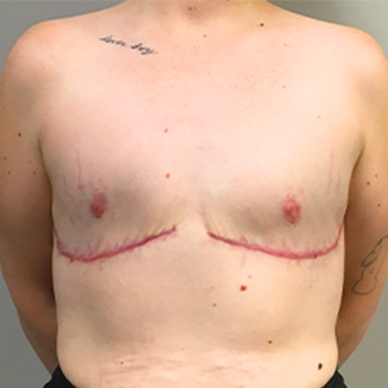 Female To Male Top Surgery 19