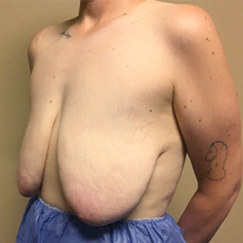 Female To Male Top Surgery 03