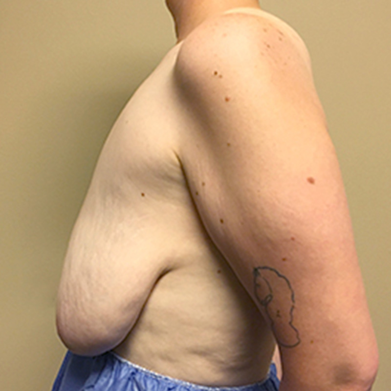 Female To Male Top Surgery 05