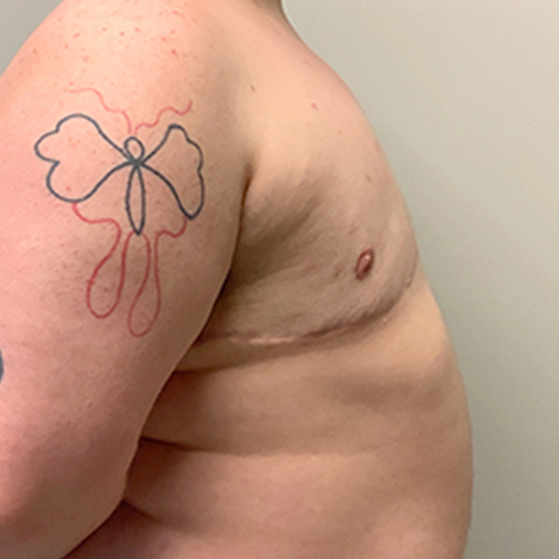 Female To Male Top Surgery 05