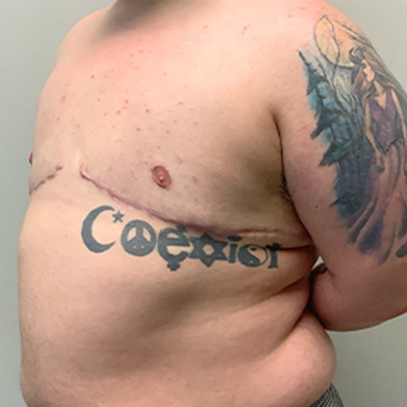 Female To Male Top Surgery 07