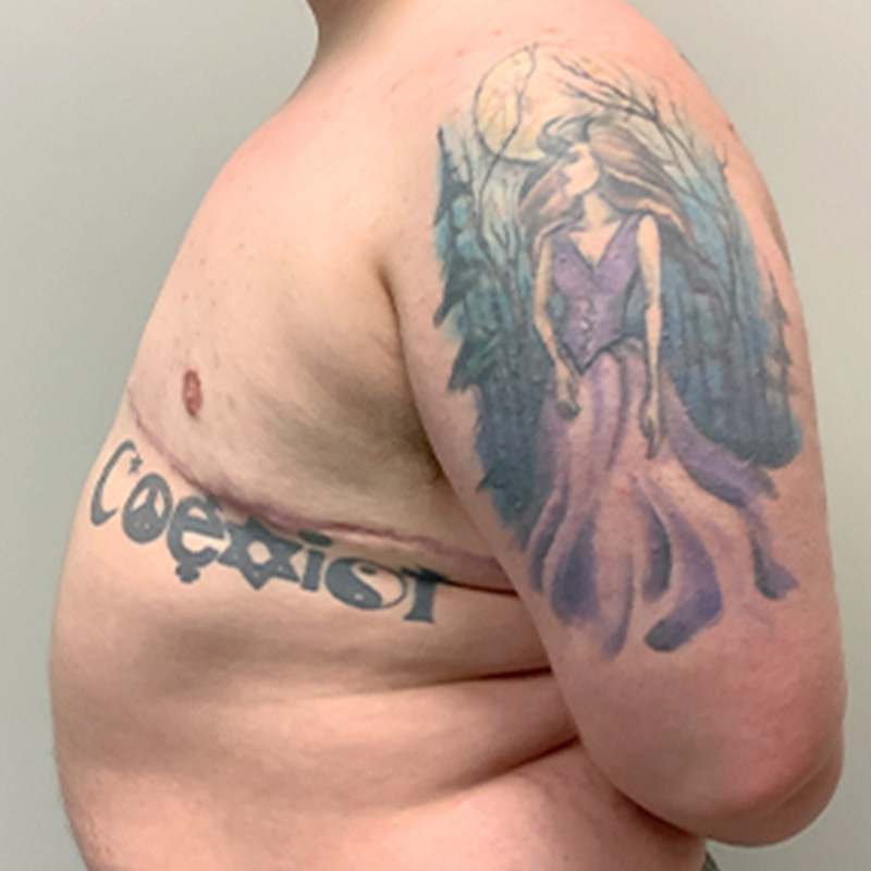 Female To Male Top Surgery 09