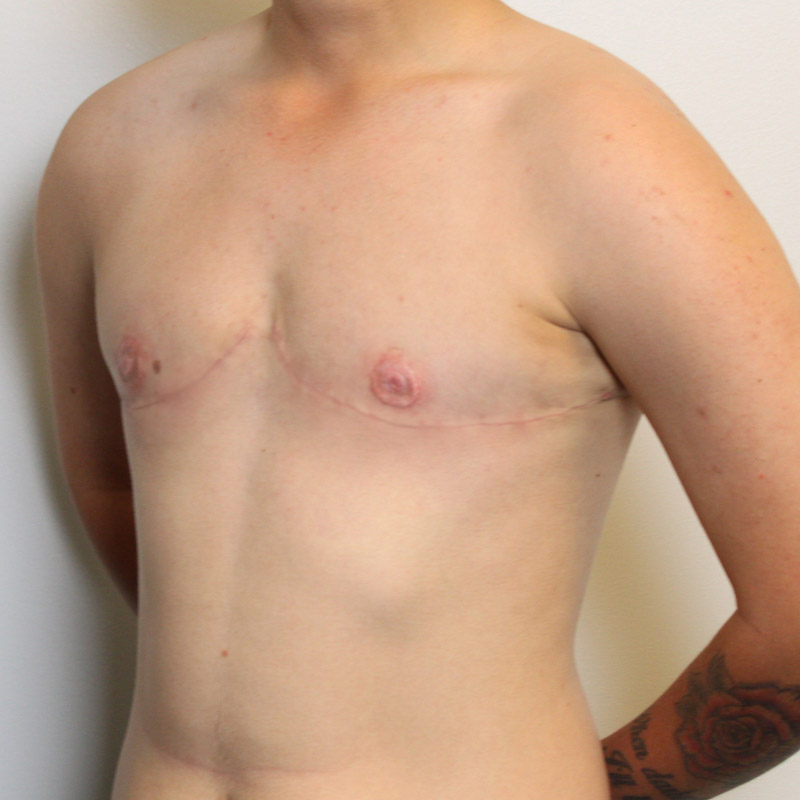 Female To Male Top Surgery 03