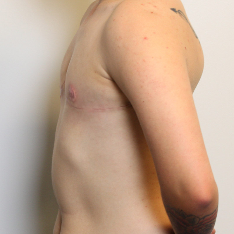 Female To Male Top Surgery 05