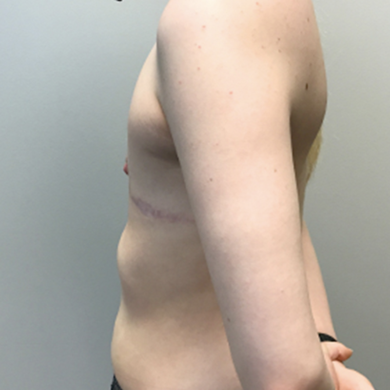 Female To Male Top Surgery 05