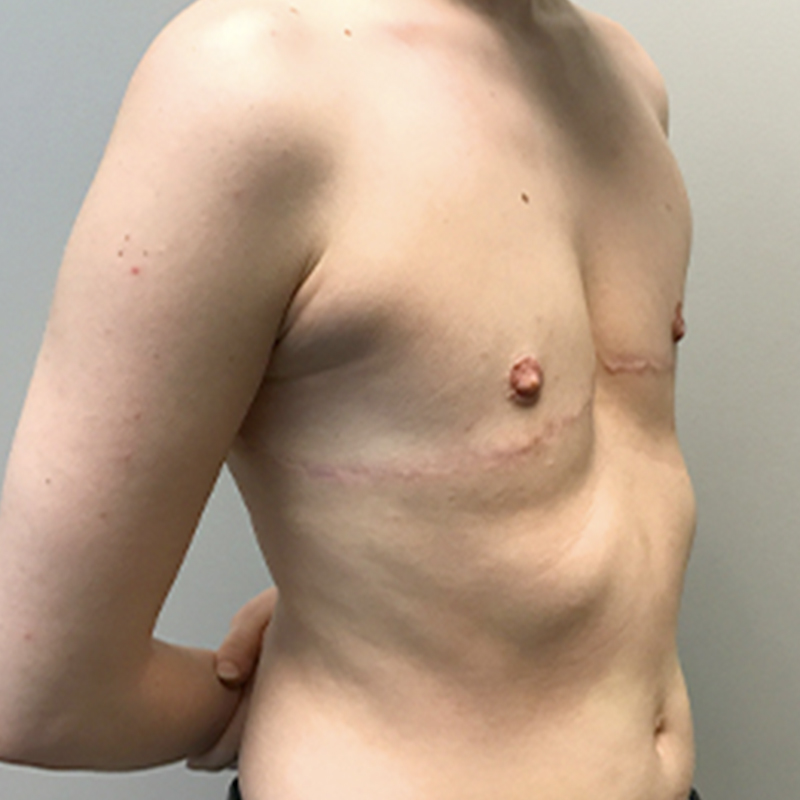 Female To Male Top Surgery 07