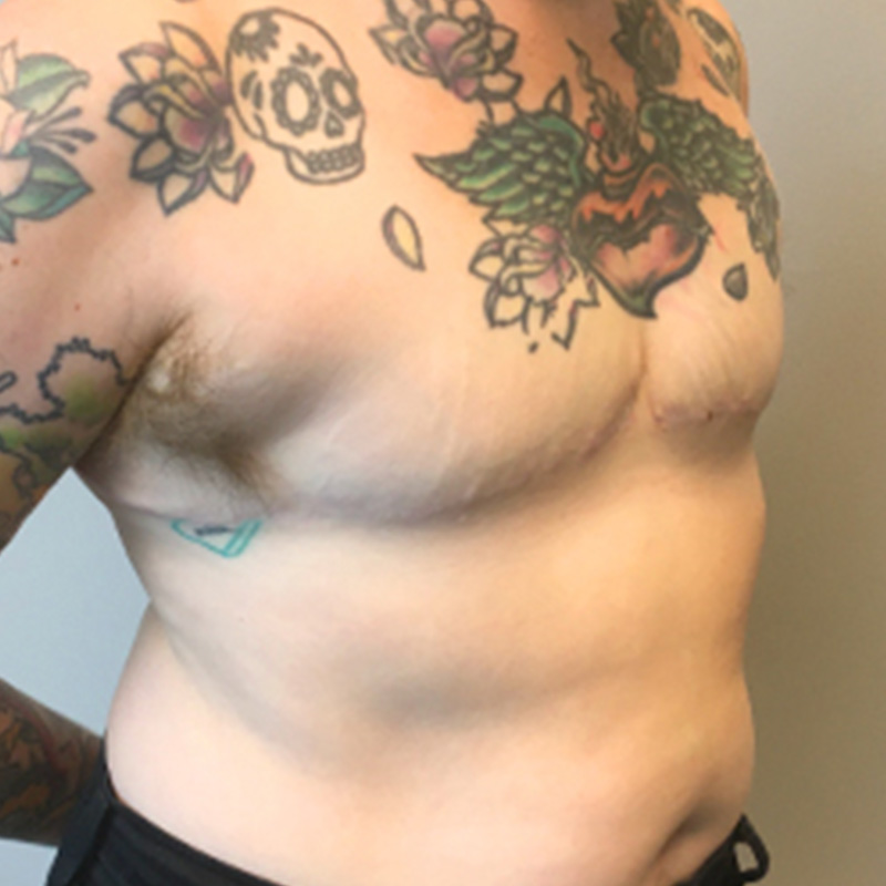 Female To Male Top Surgery 03