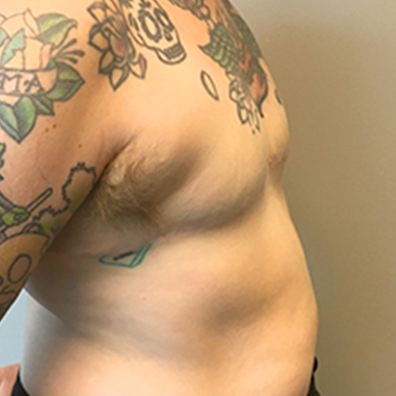 Female To Male Top Surgery 05