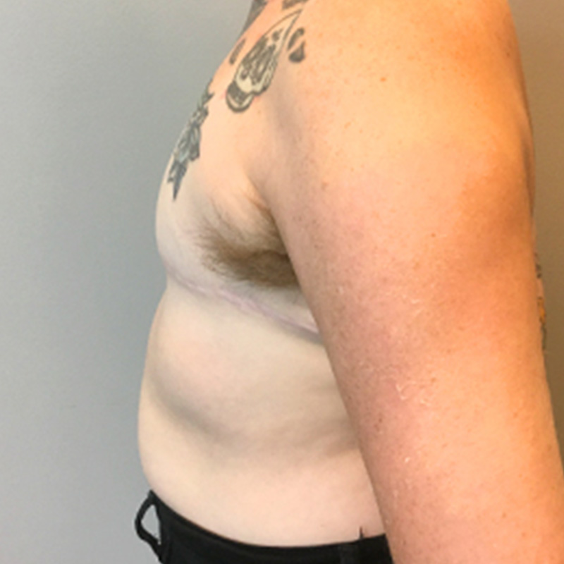 Female To Male Top Surgery 09