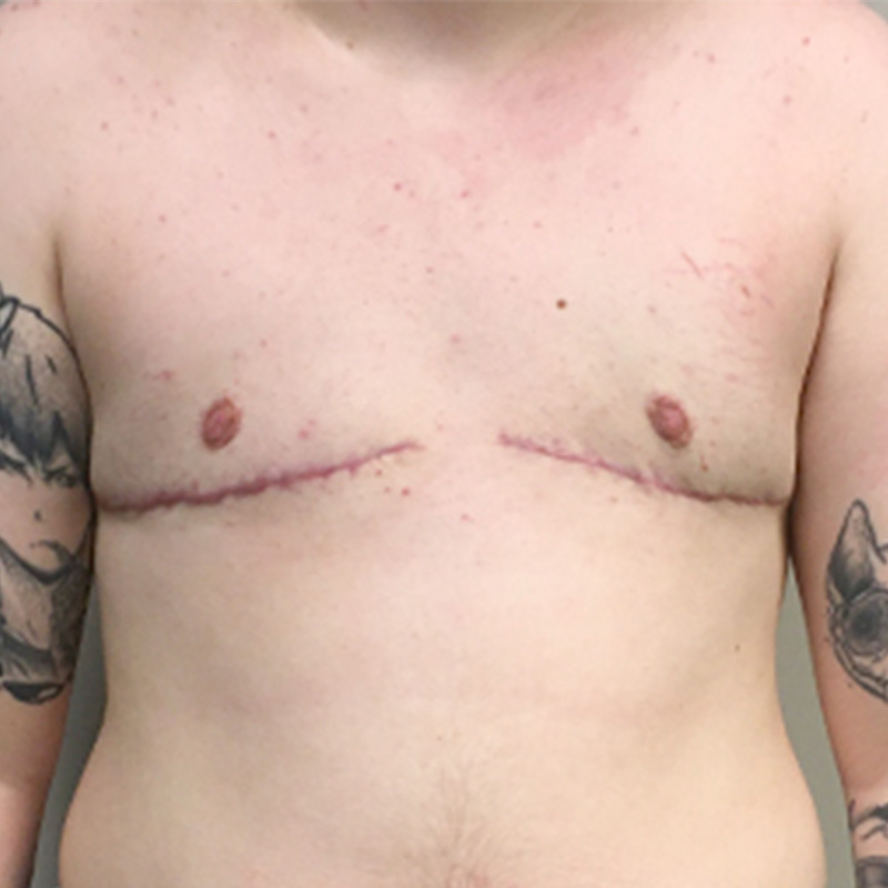 Female To Male Top Surgery 24